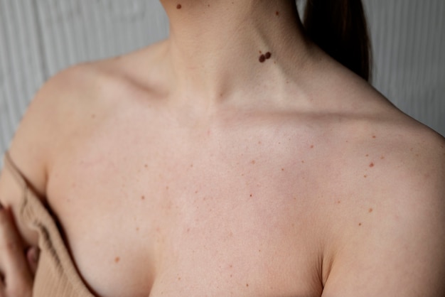 Free photo woman with melanoma on her skin