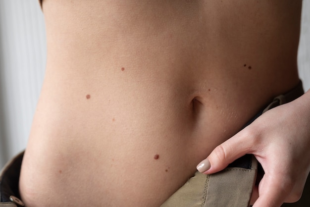 Foto gratuita donna con melanoma sulla pelle