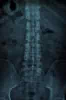 Free photo x ray of a vertebral column