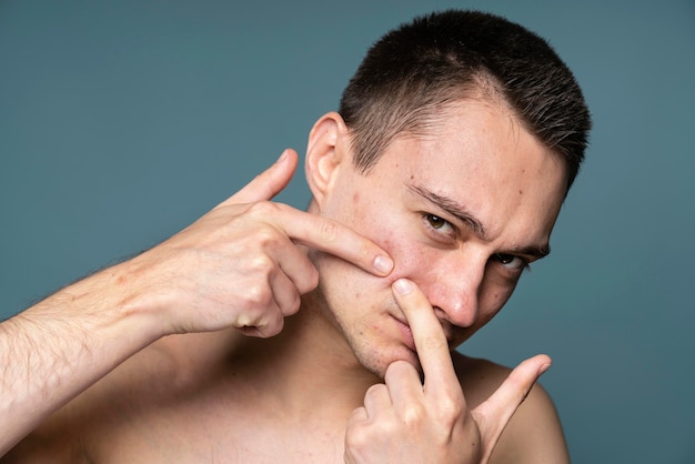 Young handsome man with acne