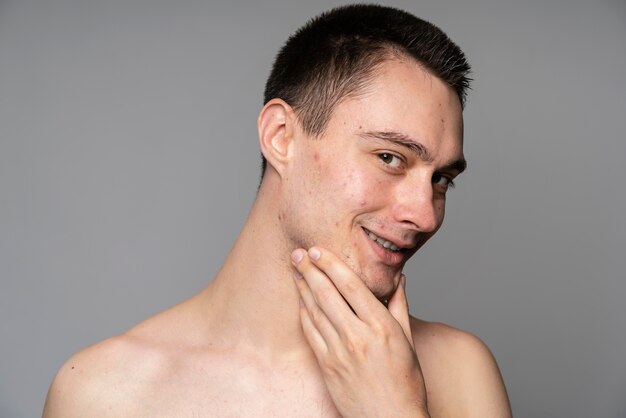 Young handsome man with acne