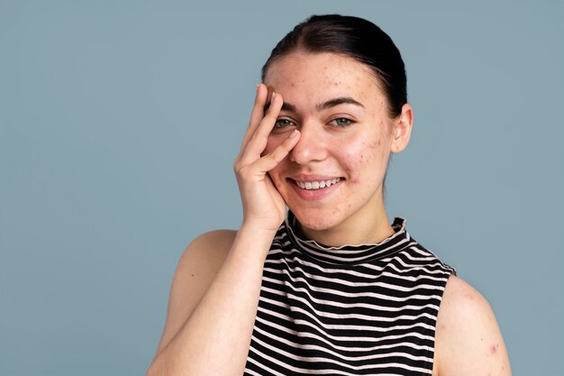 Young woman being confident with her acne