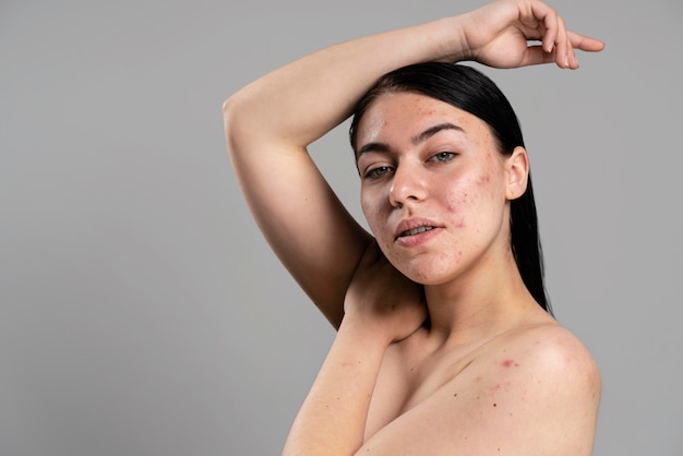 Foto gratuita giovane donna che mostra la sua acne con fiducia