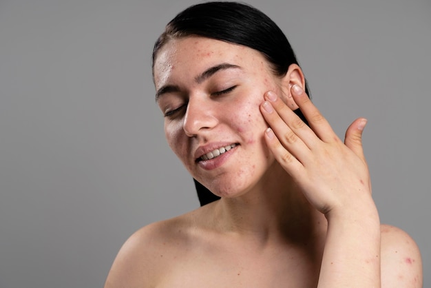 Young woman showing her acne with confidence