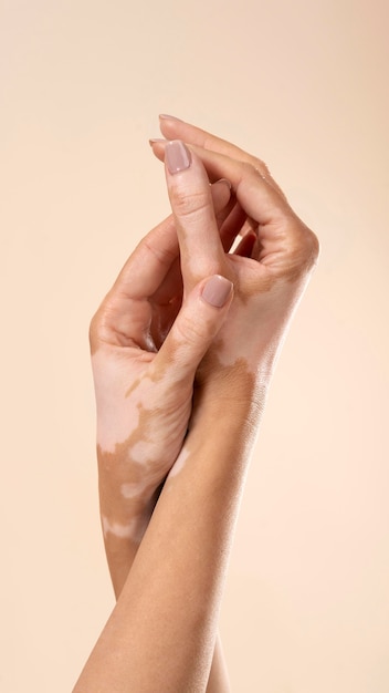 그녀의 vitiligo 피부 부분을 보여주는 젊은 여자