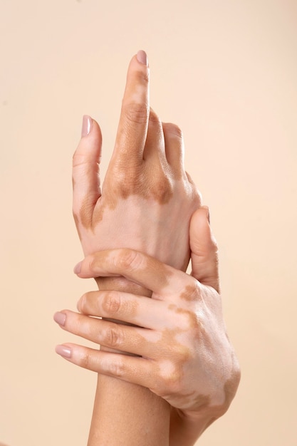 Young woman showing her vitiligo skin parts