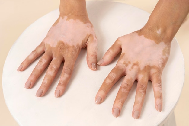 Young woman showing her vitiligo skin parts