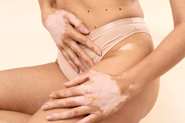 Young woman showing her vitiligo skin parts