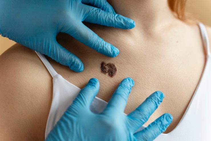 Free Photo young woman with big mole on chest