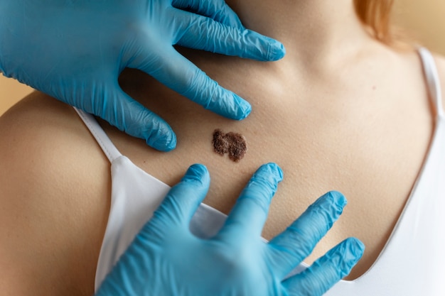 young woman with big mole on chest