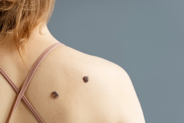 Young woman with moles back view