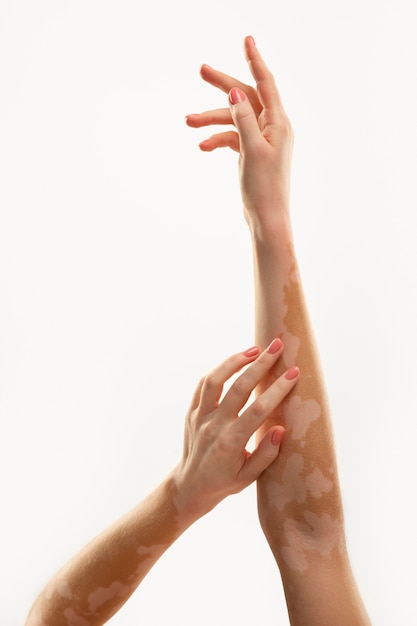 Young woman with vitiligo hands