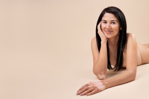 Young woman with vitiligo with copy space