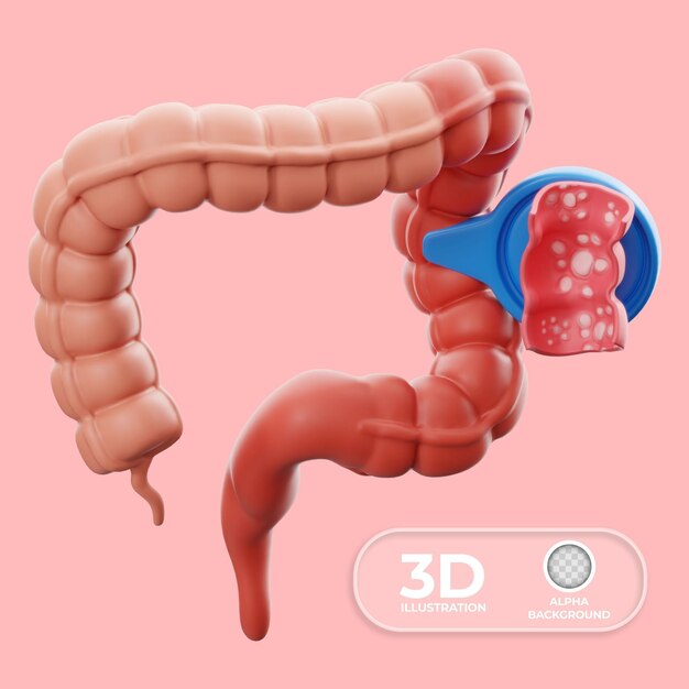 Indicating ulcerative colitis 3D illustration