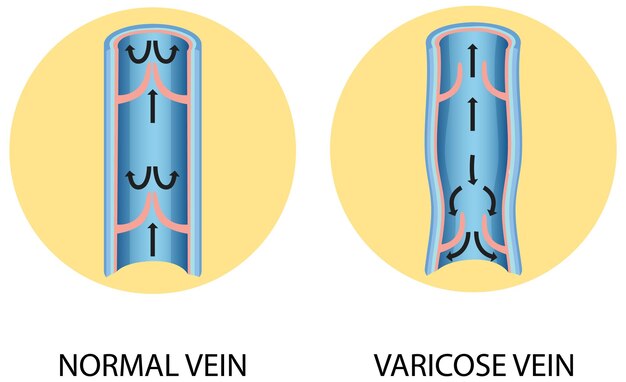 Бесплатное векторное изображение Сравнение нормальной вены с варикозной
