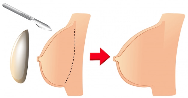 無料ベクター 乳房増強のセット