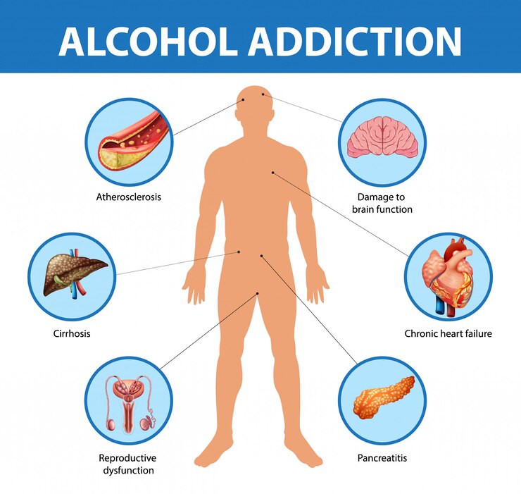 Free Vector alcohol addiction or alcoholism information infographic