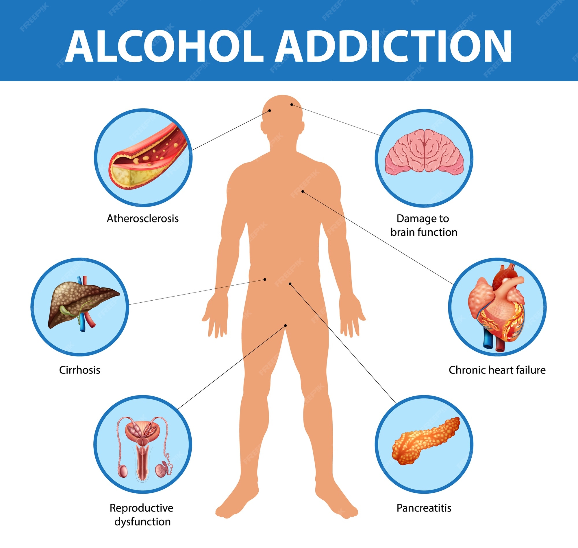 Free Vector | Alcohol addiction or alcoholism information infographic