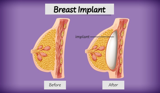 Free vector anatomy of human breast implant