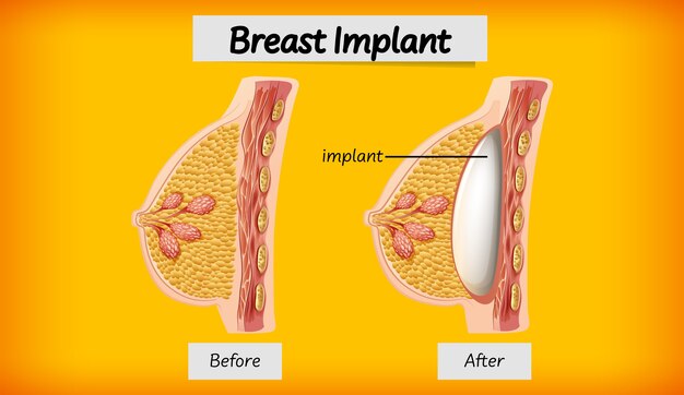 Anatomy of human breast implant