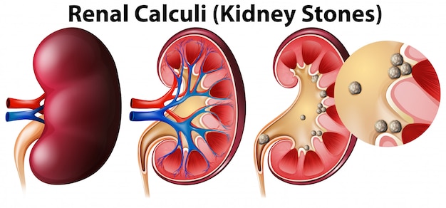 Vettore gratuito anatomia dei reni e dei calcoli renali