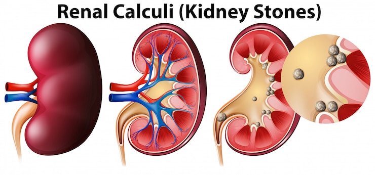 Free Vector anatomy of kidney and kidney stones