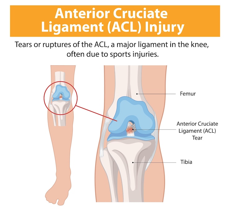 Free Vector anterior cruciate ligament acl injury