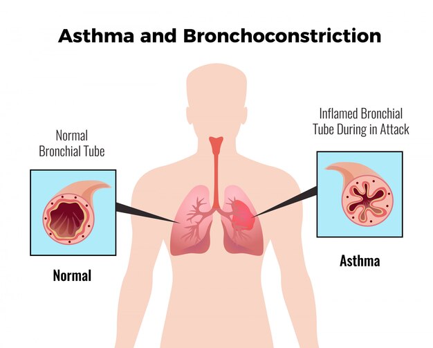 Asthma attack medical educative chart  with depiction of normal and inflamed bronchial tube flat