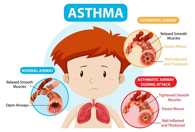 Диаграмма астмы с нормальными дыхательными путями и астматическими дыхательными путями