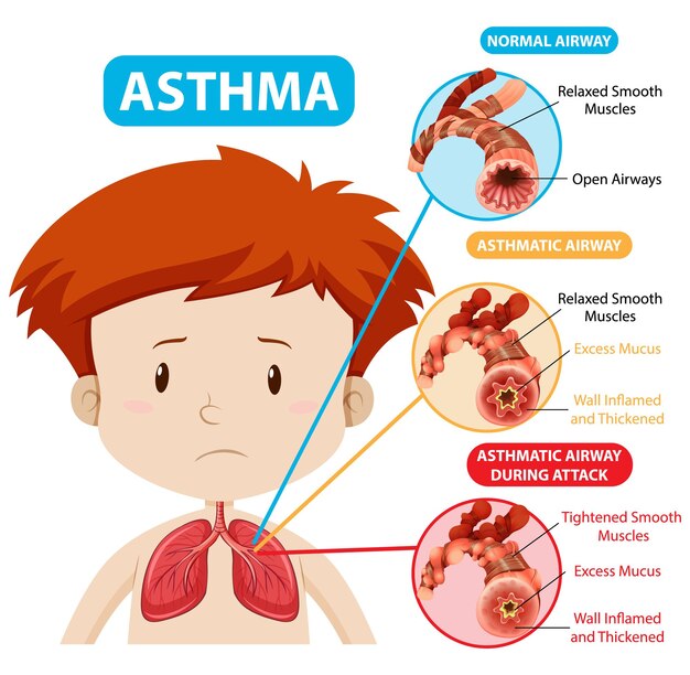 Asthma diagram with normal airway and asthmatic airway