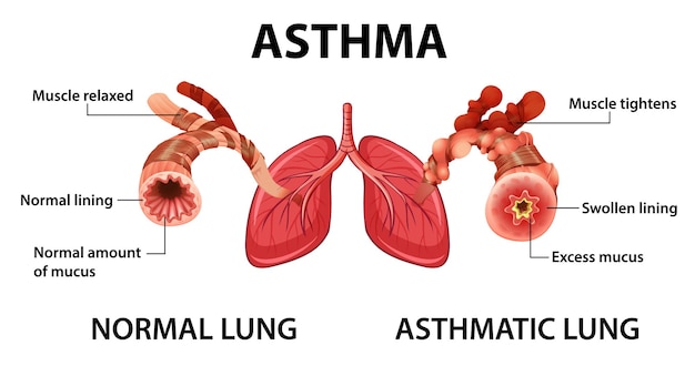Диаграмма астмы с нормальным легким и астматическим легким