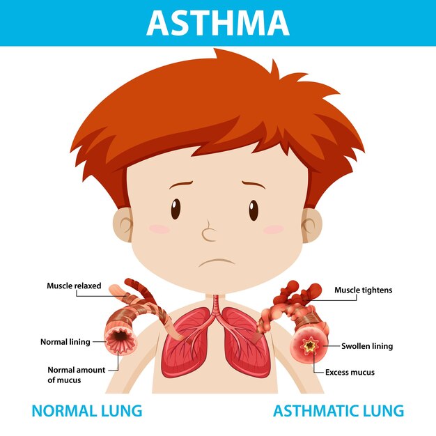 Диаграмма астмы с нормальным легким и астматическим легким