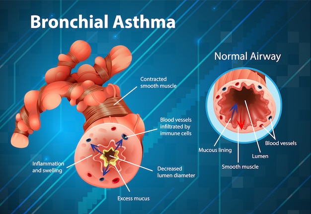 Tubo bronchiale infiammato dall'asma