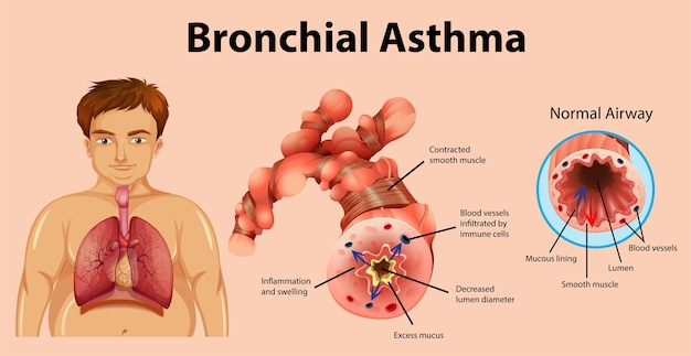 Vettore gratuito tubo bronchiale infiammato dall'asma