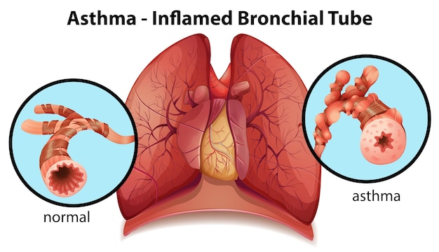 Vettore gratuito un tubo bronchiale infiammato dall'asma