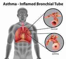 Free vector asthmainflamed bronchial tube