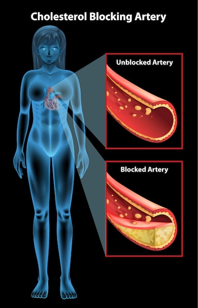 Ateriosclerosis