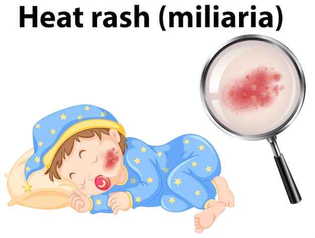 A baby with heat rash