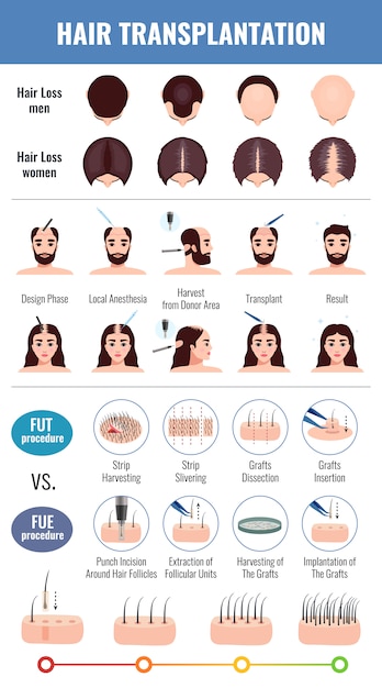 Бесплатное векторное изображение Облысение мужчин и женщин методами трансплантации волос с элементами инфографики изолированно