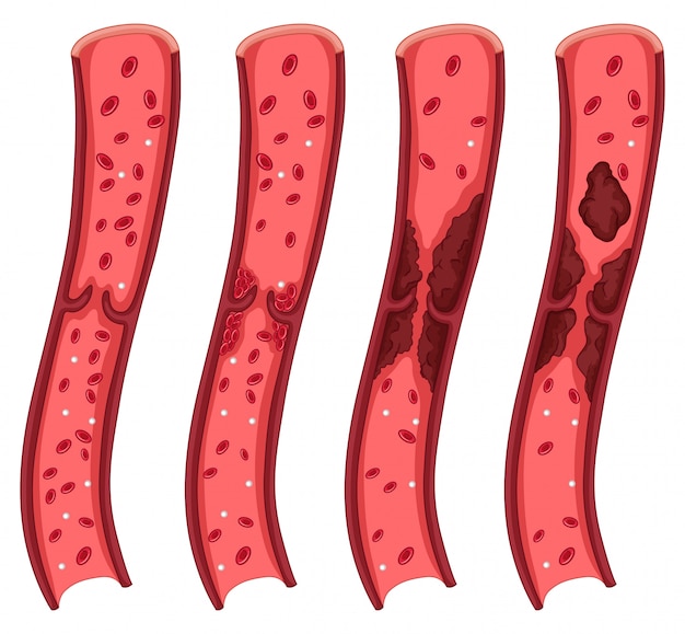 Blood Clot Diagram on White: Vector Templates