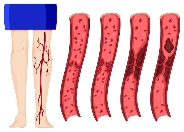 Free vector blood clot in human legs