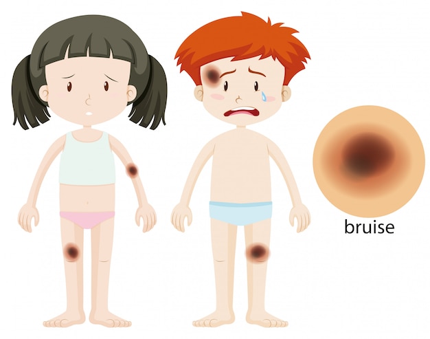 Boy and girl with bruise