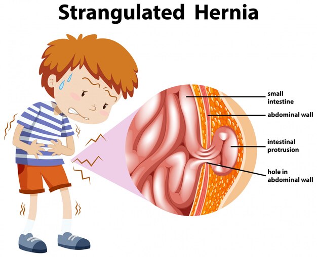 Boy with strangulated hernia on diagram