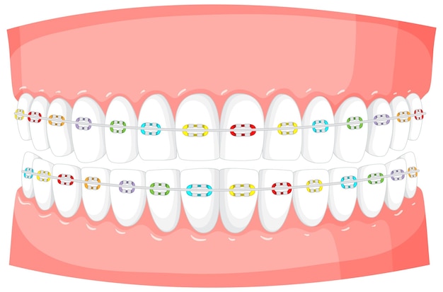 Braces on a model of human teeth on white background