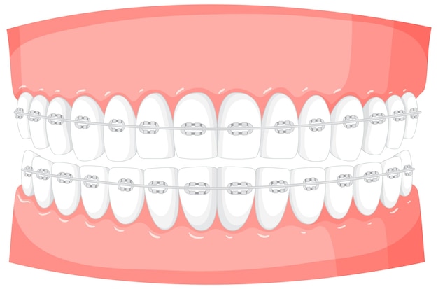 Braces on a model of human teeth