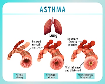 Free Vector | Bronchial asthma diagram with normal airway and asthmatic ...