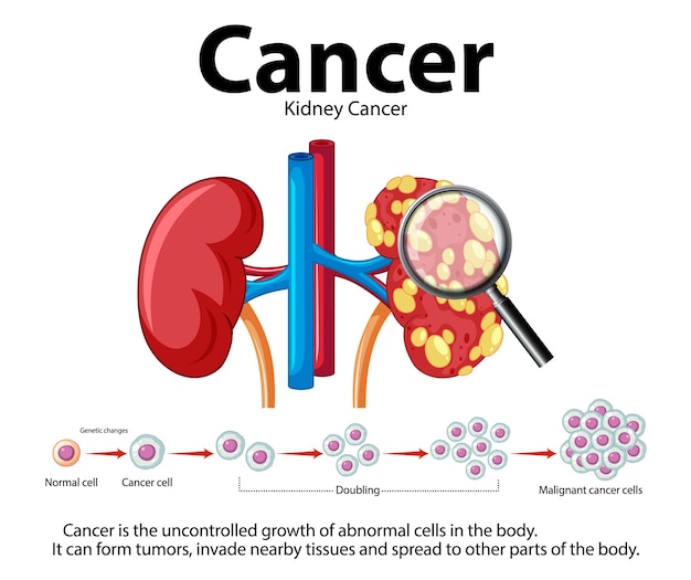 Free vector cancer development process in human kidney an infographic