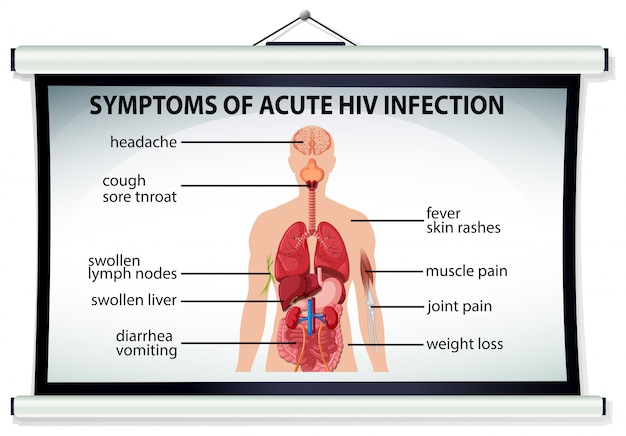 Free vector chart showing symptoms of acute hiv infection