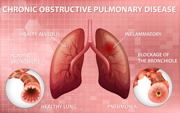 Free vector chronic obstructive pulmonary disease