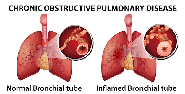 Free vector chronic obstructive pulmonary disease